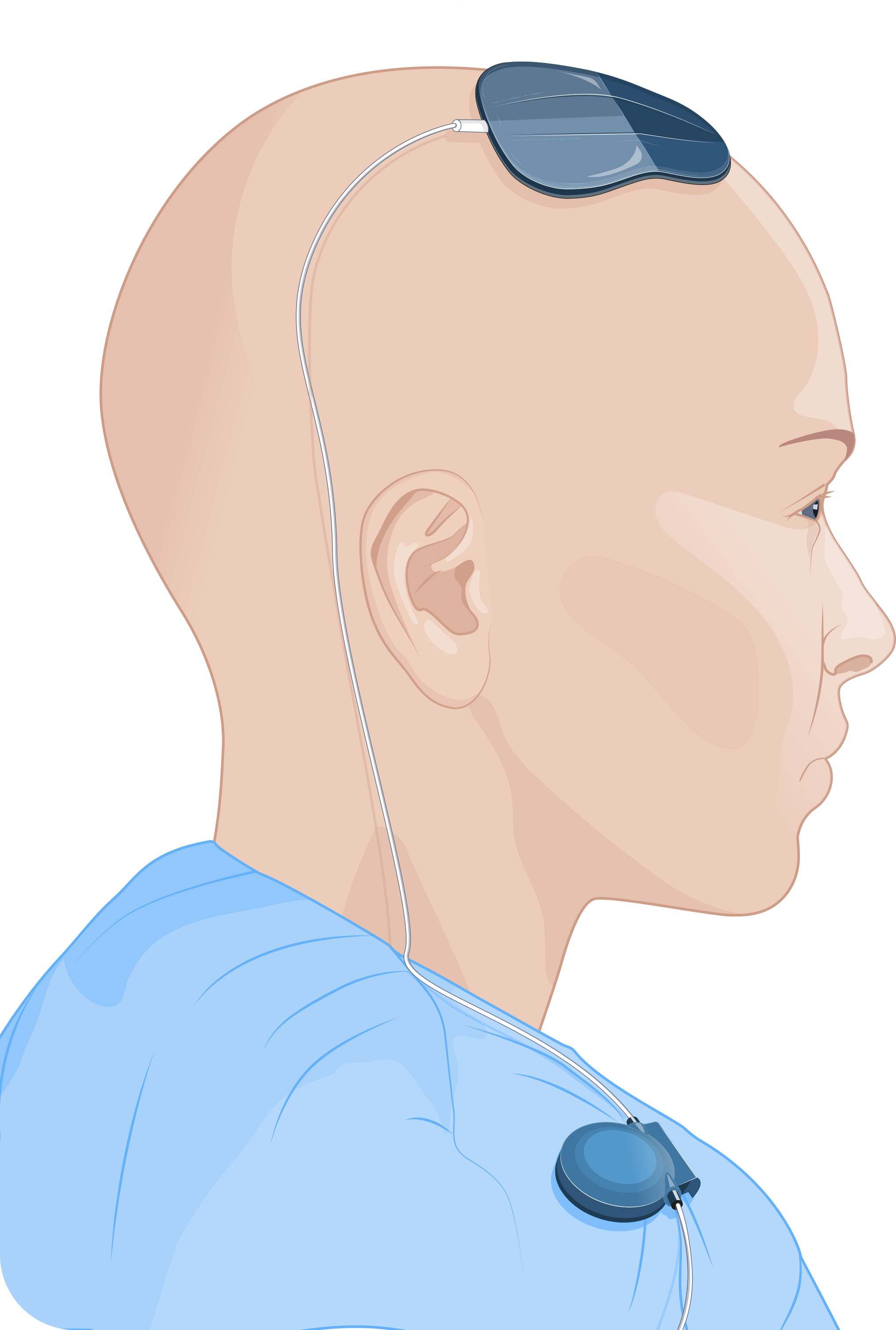 ABILITY implant - view 2